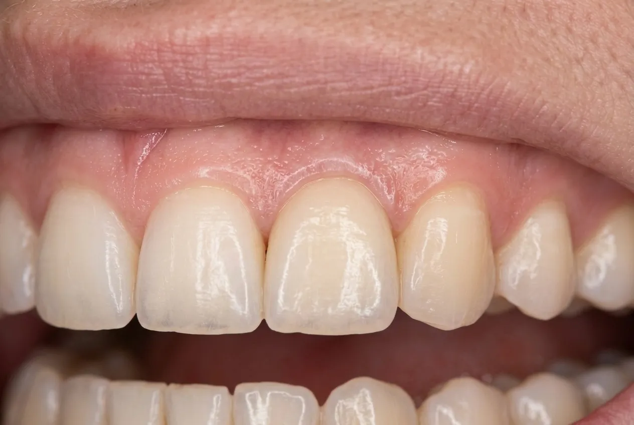Restored porcelain crown after dental implant treatment Oakville